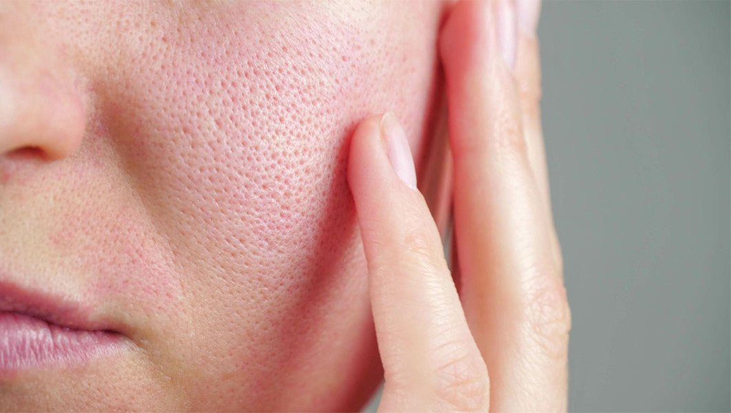 Get to the Bottom of Your Pores: Everything You Need to Know